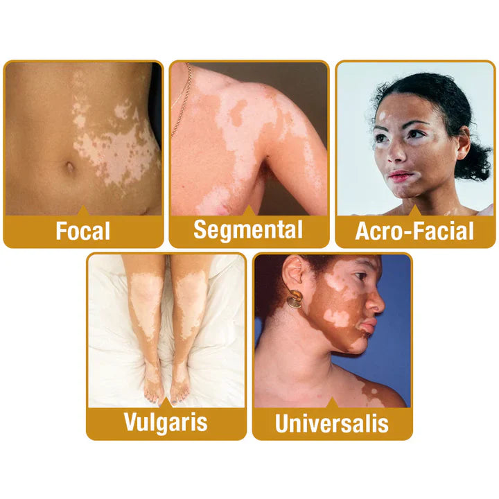 BeeVenom Vitiligo Treatment Cream